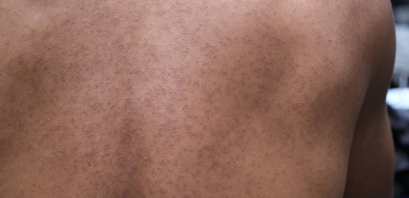 Heat Rash.jpeg